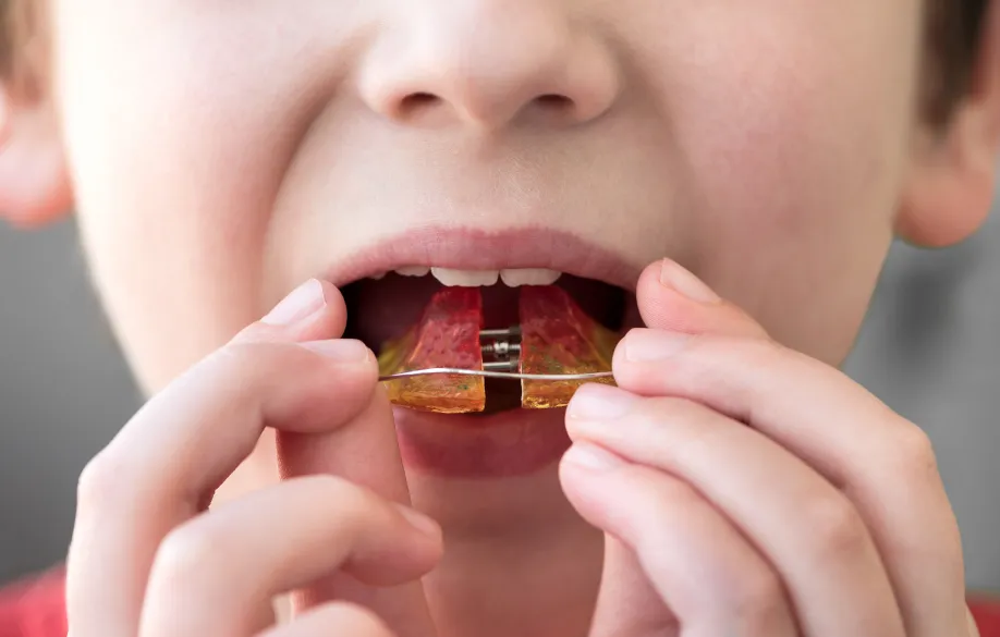 プレートを使った拡大床矯正装置